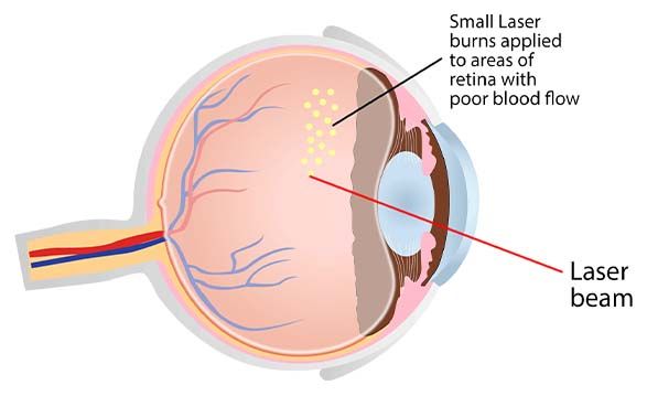 laser_retina-9797d3ad6c.jpg